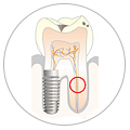 Catégorie inserts dentaires endodontie